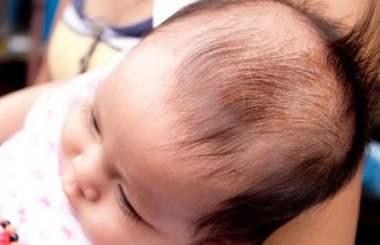 Nguyên nhân gây rụng tóc từng mảng ở trẻ sơ sinh | Vinmec